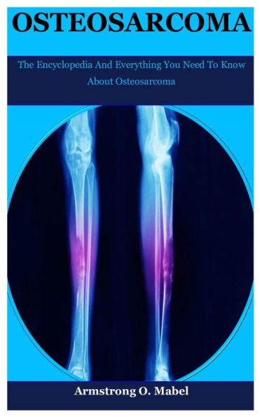 Osteosarcoma: The Encyclopedia And Everything You Need To Know About Osteosarcoma